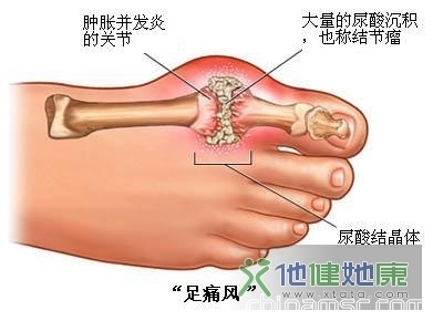 痛風病患者用藥指南：持續(xù)用藥可防復發(fā)